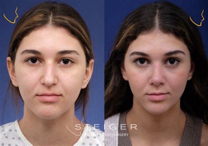 Before and After Nose Job!