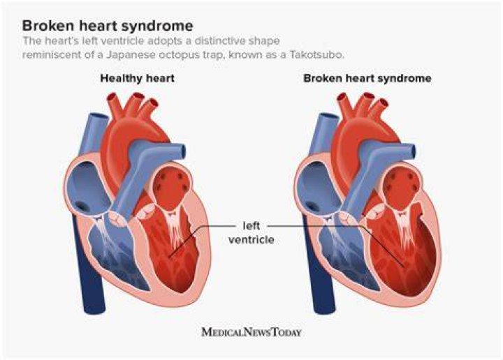 Broken Heart Syndrome – WSOC TV