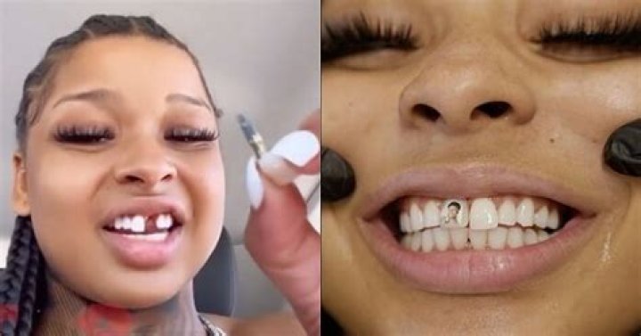 Chrisean Rock Before She Got Her Tooth Fixed