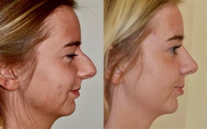 Details on Her Nose Job!