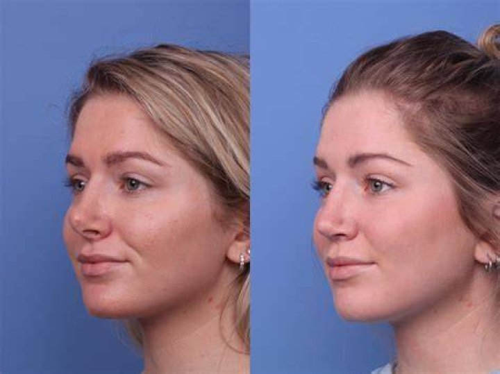 Does She Need to Have Plastic Surgery on Her Nose?