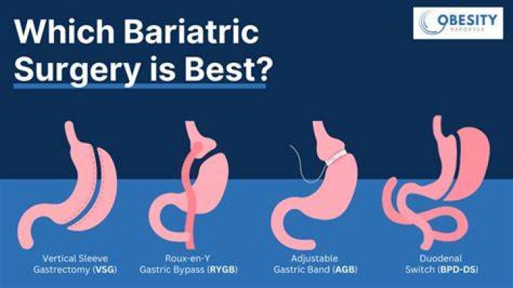 Is Bariatric Surgery Right for You?