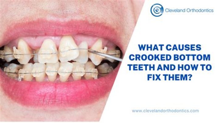 It Takes Maximum Two Years To Align Crooked Teeth