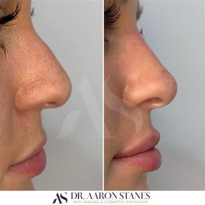 Rhinoplasty, Botox Injections & More!